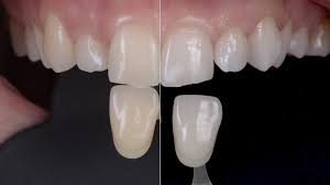 Carbamide Peroxide Teeth Whitening